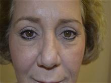 Eyelid Surgery After Photo by Joe Griffin, MD; Florence, SC - Case 29398