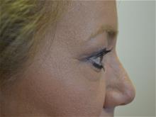 Eyelid Surgery Before Photo by Joe Griffin, MD; Florence, SC - Case 29398