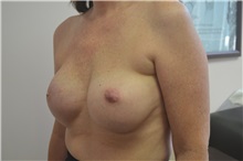 Breast Reconstruction After Photo by Joe Griffin, MD; Florence, SC - Case 33150