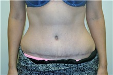 Tummy Tuck After Photo by Joe Griffin, MD; Florence, SC - Case 33154