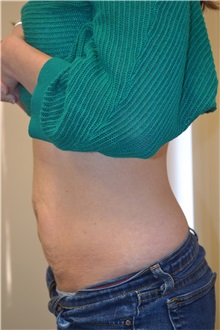 Tummy Tuck Before Photo by Joe Griffin, MD; Florence, SC - Case 33154