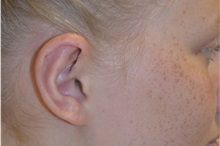 Ear Surgery After Photo by Joe Griffin, MD; Florence, SC - Case 33156