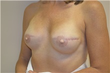 Breast Reconstruction After Photo by Joe Griffin, MD; Florence, SC - Case 33177