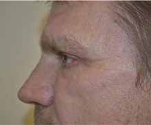 Eyelid Surgery After Photo by Joe Griffin, MD; Florence, SC - Case 33515