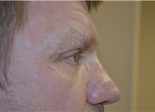 Eyelid Surgery After Photo by Joe Griffin, MD; Florence, SC - Case 33515