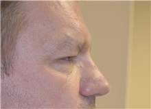 Eyelid Surgery Before Photo by Joe Griffin, MD; Florence, SC - Case 33515