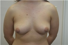 Breast Augmentation Before Photo by Joe Griffin, MD; Florence, SC - Case 33516