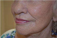 Dermal Fillers Before Photo by Joe Griffin, MD; Florence, SC - Case 33517