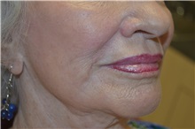 Dermal Fillers After Photo by Joe Griffin, MD; Florence, SC - Case 33517