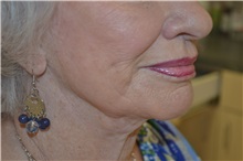 Dermal Fillers Before Photo by Joe Griffin, MD; Florence, SC - Case 33517