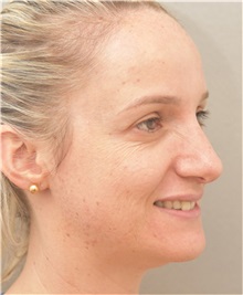 Rhinoplasty After Photo by Arthur Jabs, MD, PhD; Bethesda, MD - Case 37647