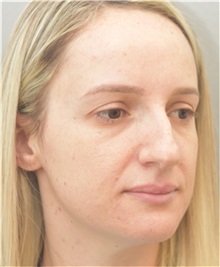 Rhinoplasty Before Photo by Arthur Jabs, MD, PhD; Bethesda, MD - Case 37647