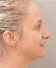 Rhinoplasty After Photo by Arthur Jabs, MD, PhD; Bethesda, MD - Case 37647