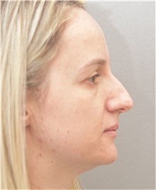 Rhinoplasty Before Photo by Arthur Jabs, MD, PhD; Bethesda, MD - Case 37647