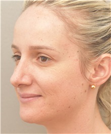 Rhinoplasty After Photo by Arthur Jabs, MD, PhD; Bethesda, MD - Case 37647