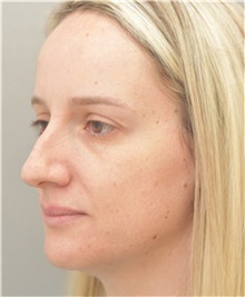 Rhinoplasty Before Photo by Arthur Jabs, MD, PhD; Bethesda, MD - Case 37647