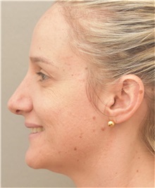 Rhinoplasty After Photo by Arthur Jabs, MD, PhD; Bethesda, MD - Case 37647