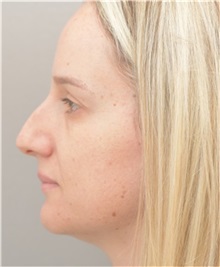 Rhinoplasty Before Photo by Arthur Jabs, MD, PhD; Bethesda, MD - Case 37647