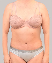 Tummy Tuck After Photo by Arthur Jabs, MD, PhD; Bethesda, MD - Case 37648