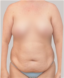 Tummy Tuck Before Photo by Arthur Jabs, MD, PhD; Bethesda, MD - Case 37648