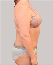 Tummy Tuck After Photo by Arthur Jabs, MD, PhD; Bethesda, MD - Case 37648