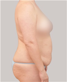 Tummy Tuck Before Photo by Arthur Jabs, MD, PhD; Bethesda, MD - Case 37648