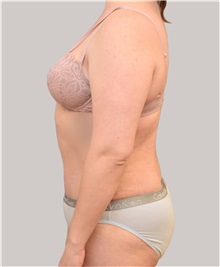 Tummy Tuck After Photo by Arthur Jabs, MD, PhD; Bethesda, MD - Case 37648