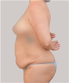 Tummy Tuck Before Photo by Arthur Jabs, MD, PhD; Bethesda, MD - Case 37648