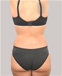 Liposuction After Photo by Arthur Jabs, MD, PhD; Bethesda, MD - Case 37650