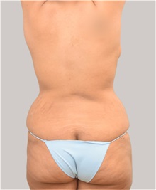 Liposuction Before Photo by Arthur Jabs, MD, PhD; Bethesda, MD - Case 37650