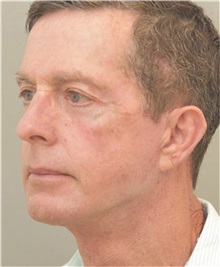 Facelift After Photo by Arthur Jabs, MD, PhD; Bethesda, MD - Case 37651