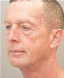 Facelift Before Photo by Arthur Jabs, MD, PhD; Bethesda, MD - Case 37651