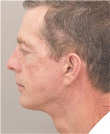 Facelift After Photo by Arthur Jabs, MD, PhD; Bethesda, MD - Case 37651