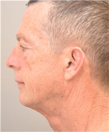 Facelift Before Photo by Arthur Jabs, MD, PhD; Bethesda, MD - Case 37651
