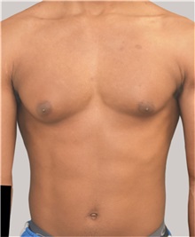 Male Breast Reduction Before Photo by Arthur Jabs, MD, PhD; Bethesda, MD - Case 37652