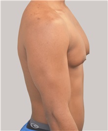 Male Breast Reduction Before Photo by Arthur Jabs, MD, PhD; Bethesda, MD - Case 37652