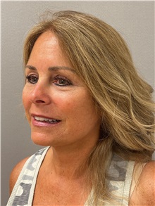 Facelift After Photo by Arthur Jabs, MD, PhD; Bethesda, MD - Case 49435