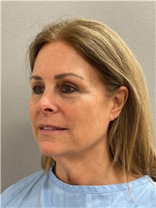 Facelift Before Photo by Arthur Jabs, MD, PhD; Bethesda, MD - Case 49435