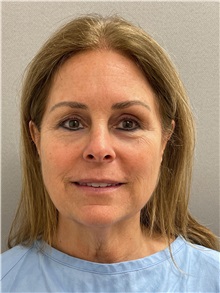 Facelift Before Photo by Arthur Jabs, MD, PhD; Bethesda, MD - Case 49435