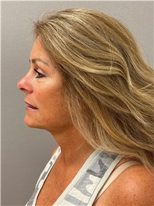 Facelift After Photo by Arthur Jabs, MD, PhD; Bethesda, MD - Case 49435