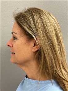 Facelift Before Photo by Arthur Jabs, MD, PhD; Bethesda, MD - Case 49435