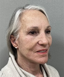 Facelift After Photo by Arthur Jabs, MD, PhD; Bethesda, MD - Case 49438