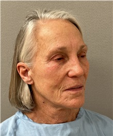 Facelift Before Photo by Arthur Jabs, MD, PhD; Bethesda, MD - Case 49438