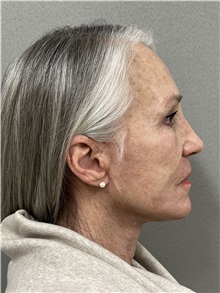 Facelift After Photo by Arthur Jabs, MD, PhD; Bethesda, MD - Case 49438