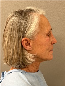 Facelift Before Photo by Arthur Jabs, MD, PhD; Bethesda, MD - Case 49438