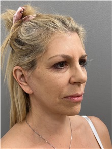 Facelift After Photo by Arthur Jabs, MD, PhD; Bethesda, MD - Case 49433