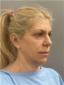 Facelift Before Photo by Arthur Jabs, MD, PhD; Bethesda, MD - Case 49433