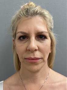 Facelift After Photo by Arthur Jabs, MD, PhD; Bethesda, MD - Case 49433