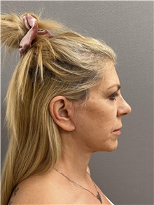 Facelift After Photo by Arthur Jabs, MD, PhD; Bethesda, MD - Case 49433