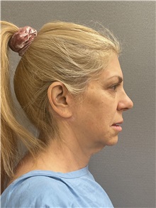 Facelift Before Photo by Arthur Jabs, MD, PhD; Bethesda, MD - Case 49433